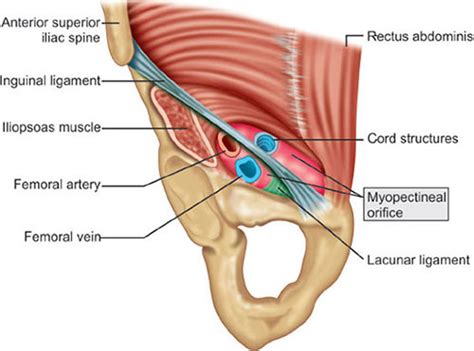 Iliopubic Tract Vs Inguinal Ligament