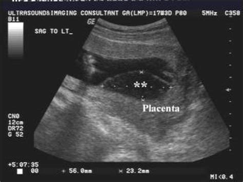 Placental Hemorrhage Ultrasound