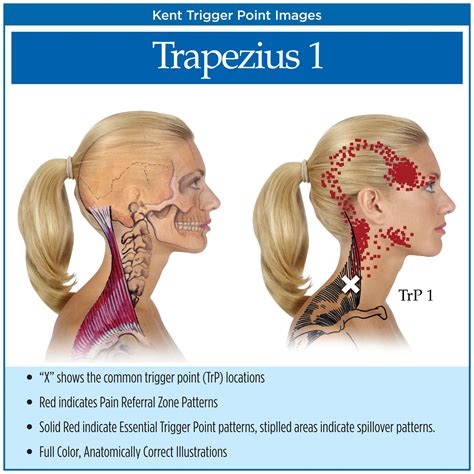 Trigger Point Charts (5 Chart Set) - Kent Health Systems