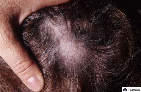 Lupus Hair Loss | Causes, Symptoms and Treatment Options