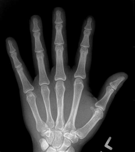 hand arthritis on x-rays | Raleigh Hand to Shoulder Center