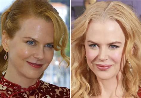 Nicole Kidman Plastic Surgery Before and After Botox Injections | Celebie