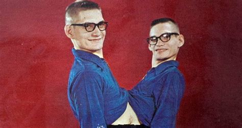 Ronnie And Donnie Galyon: The Longest-Living Conjoined Twins In History