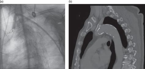 Cardiothoracic and Thoracic Vascular Injury | Anesthesia Key