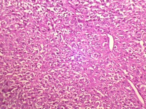 Histology Of Osteosarcoma