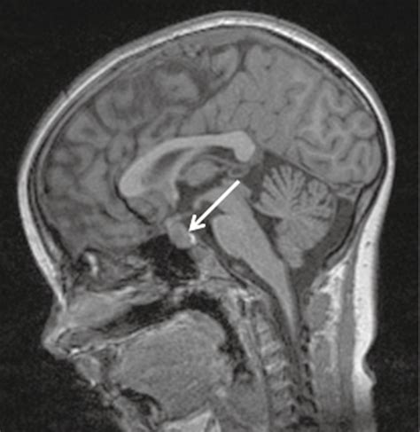 Reactive pituitary hyperplasia associated with paediatric primary ...