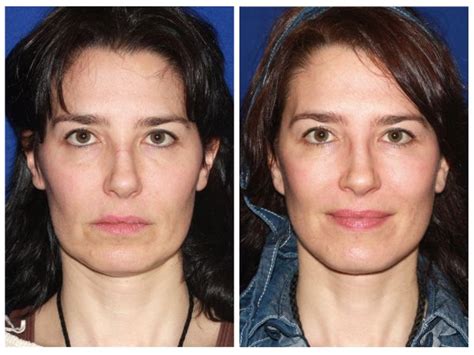 Full Facelift vs Mini Facelift: What’s the Difference? | Konstantin ...