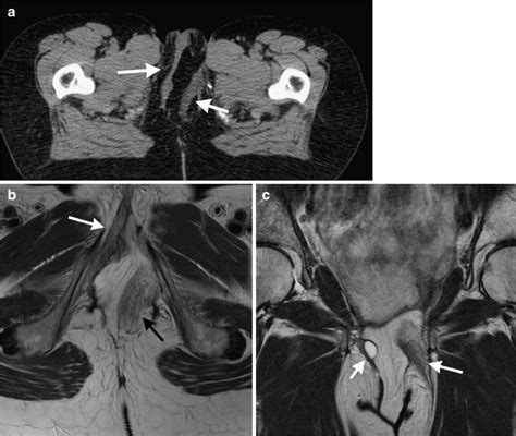 Normal gracilis flap recipient site appearances on CT and MRI. Patient ...