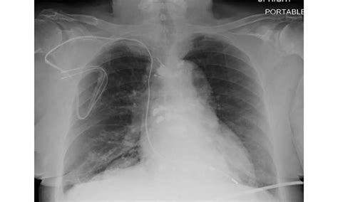 MRI safely performed in patients with pacemakers and ICDs