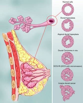 Invasive Lobular Breast Cancer- Chemo? - PeopleBeatingCancer