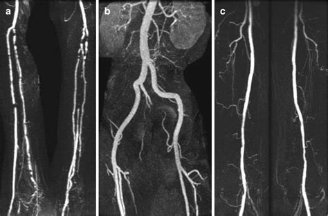 Imaging Approaches and Challenges in the Assessment of Peripheral ...