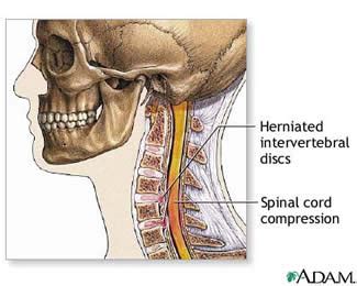 Herniated Disc – Cervical » Lillian S. Wells Department of Neurosurgery ...