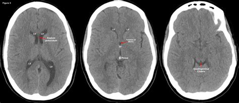 The ED Guide to Neuroimaging: Part 1 — NUEM Blog