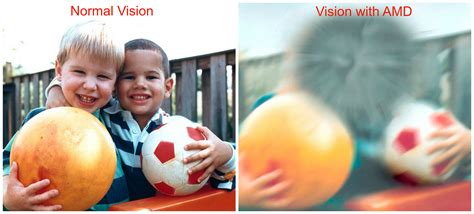 Macular Degeneration, Everything You Need To Know