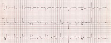 Inferior STEMI • LITFL • ECG Library Diagnosis