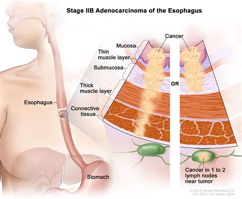 kanser esofagus (esophageal cancer) - Wanda Miller