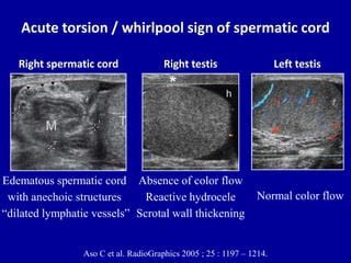 Doppler ultrasound of acute scrotum | PPT