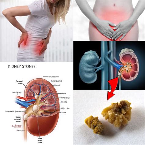 HOW TO REMOVE KIDNEY STONE AT HOME - KIDNEY STONE HOME REMEDY - KIDNEY ...