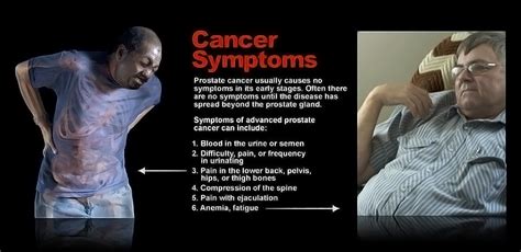 Symptoms of Advanced Prostate Cancer - StoryMD