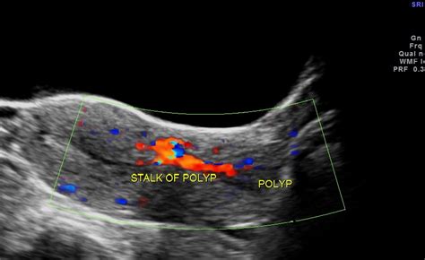 ENDOMETRIAL POLYP WITH A STALK PRESENTING IN THE CERVIX | Looking ...