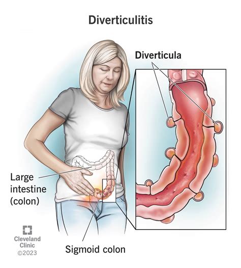 Diverticulitis: Symptoms, Causes & Treatment