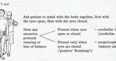 Teach Neurology: Cerebellar ataxia and Romberg's test