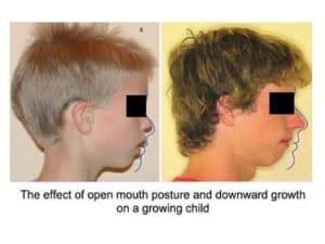 Mouth Breather Face-What Causes it and How to Fix it