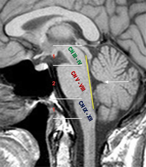 Sagittal T1-weighted MRI of the brainstem showing normal features of ...