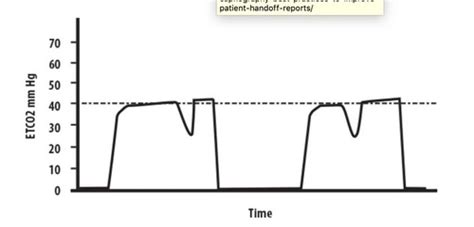 Capnography Waveform - ETCO2 Flashcards | Quizlet