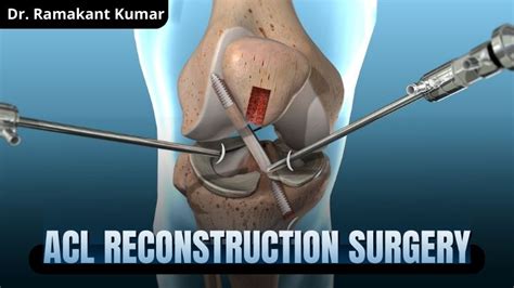 ACL Reconstruction Surgery: Whatever You Need to Know!