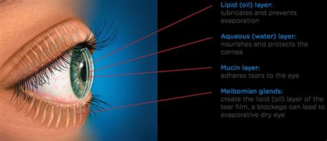 What is Meibomian Gland Dysfunction? | The Dry Eye Treatment Center