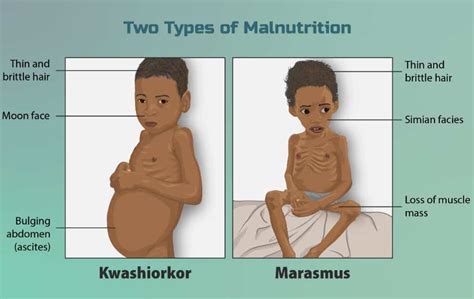 Malnutrition in India its types, causes and effects | UPSC – IAS ...