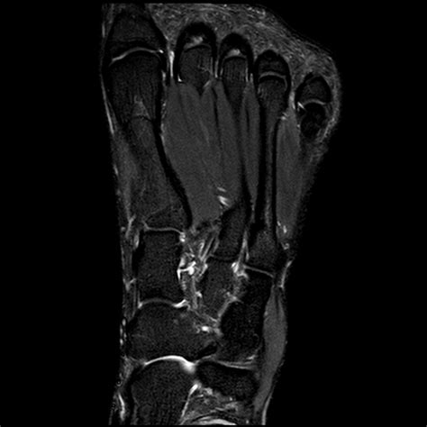 Foot Mri Anatomy - Anatomy Reading Source