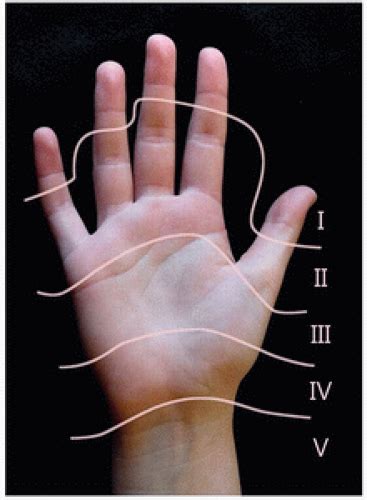 Zone II Flexor Tendon Repair | Musculoskeletal Key