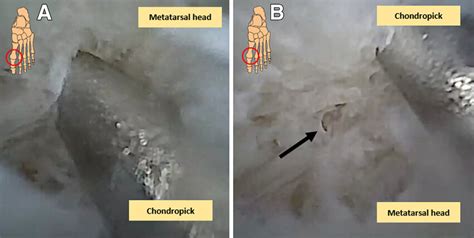 (A and B) Intra-articular chondral picking of the (osteo) chondral ...