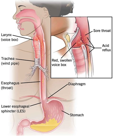 GASTROESOPHAGEAL REFLUX DISEASE (GERD) - BIMS Hospital