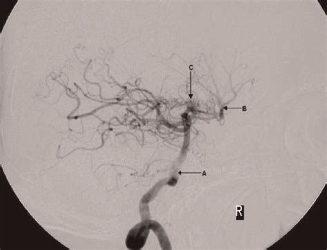 Angiogram demonstrating posterior circulation and moyamoya vessels; a ...