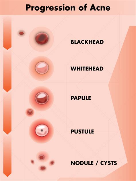 How to Tell the Difference Between Herpes and Pimples (With Photos ...