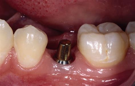 Dental Implant Abutment - Dental News Network