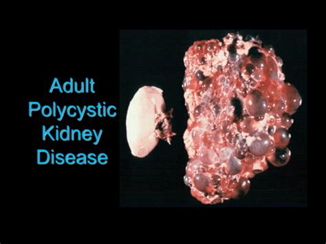 Adult Polycystic Kidney Disease