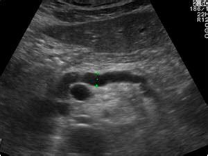 Abdomen and retroperitoneum | 1.2 Gallbladder and bile ducts : Case 1.2 ...