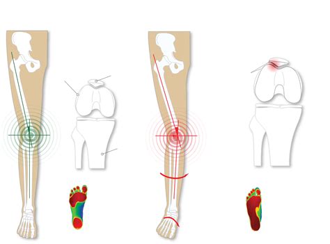 What Causes Pronation Of Foot