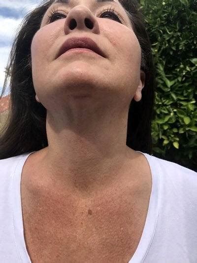 Lower Facelift Scars Under Chin (1) » Facelift: Info, Prices, Photos ...