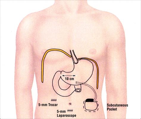 Gastric Electrical Stimulation: An Alternative Surgical Therapy for ...