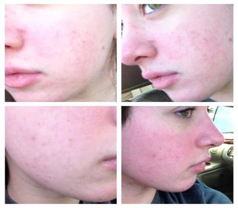 Accutane rash on face, accutane rash on face - | LETSJUSTBECLEAR