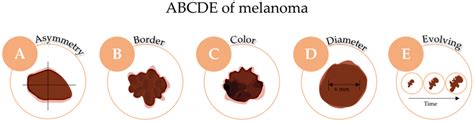 The ABCDE rule for melanoma skin cancer diagnosis. | Download ...