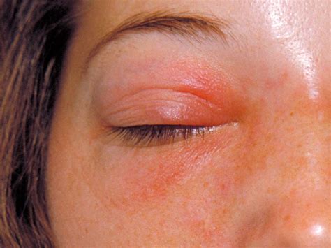 Orbital cellulitis: Symptoms, causes, and treatment