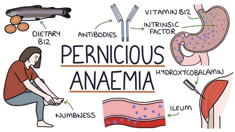 Understanding Pernicious Anaemia (B12 Deficiency) - YouTube