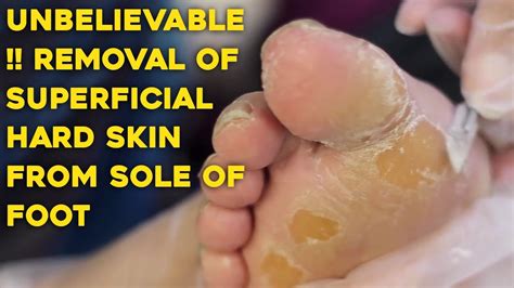 Unbelievable !! Removal of Superficial Hard Skin From Sole of Foot By ...