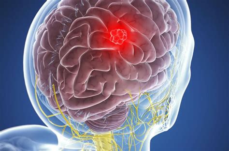 Meningioma Diagnosis, Risks, and Grades